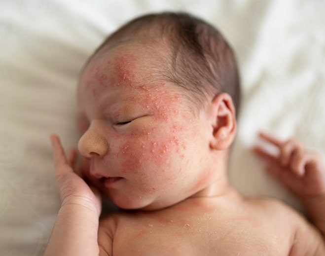 How to Get Rid Baby Acne